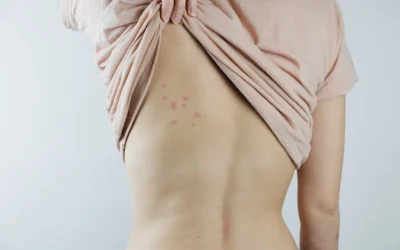 ¿Qué debo hacer si me pica una chinche?